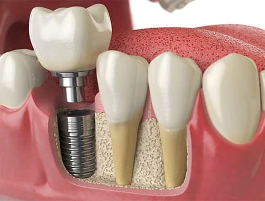 MDS - Prosthodontist & Implantologist
