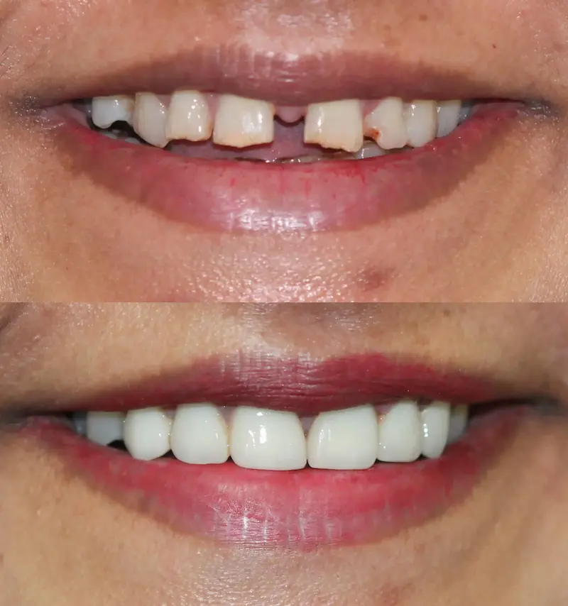 Top Left : Before smile makeover with broken and spaced front teeth – Rarity Dental Gurgaon 
 Bottom Left: After smile makeover with aligned and restored teeth – Rarity Dental Gurgaon