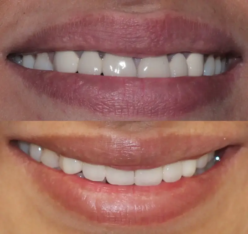 Top Right : Before image showing crooked upper teeth – Rarity Dental Gurgaon 
 Bottom Right: After cosmetic dental treatment with even natural smile – Rarity Dental Gurgaon