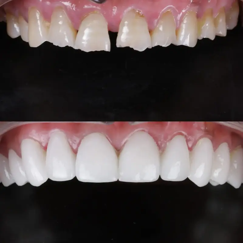 Top Left : Before treatment showing decayed misaligned teeth – Rarity Dental Gurgaon 
 Bottom Left: After makeover with restored white teeth – Rarity Dental Gurgaon