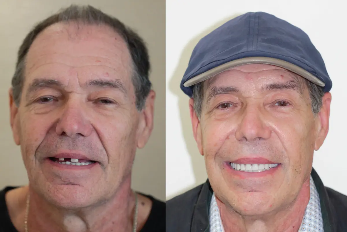 Male patient with cap 

			Left (Before): 

			Before smile restoration of male with broken front teeth – Rarity Dental Gurgaon 

			Right (After): 

			After dental treatment with full natural-looking smile – Rarity Dental Gurgaon