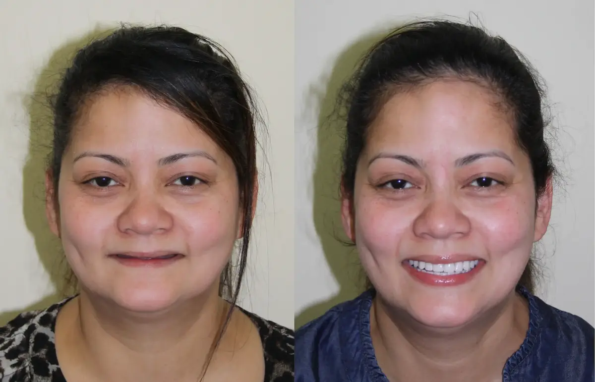 Image – Female patient (front face) 

			Left (Before): 

			Before smile makeover of female with discolored and missing teeth – Rarity Dental Gurgaon 

			Right (After): 

			After smile transformation with natural-looking restored teeth – Rarity Dental Gurgaon