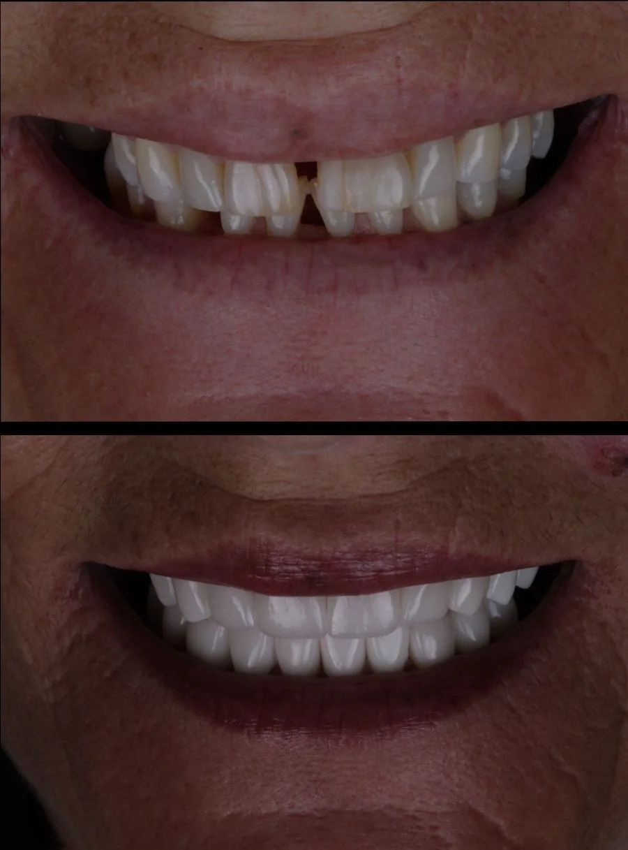 Top Right : Before image with missing and uneven front teeth – Rarity Dental Gurgaon 
 Bottom Right: After smile transformation with aligned natural teeth – Rarity Dental Gurgaon