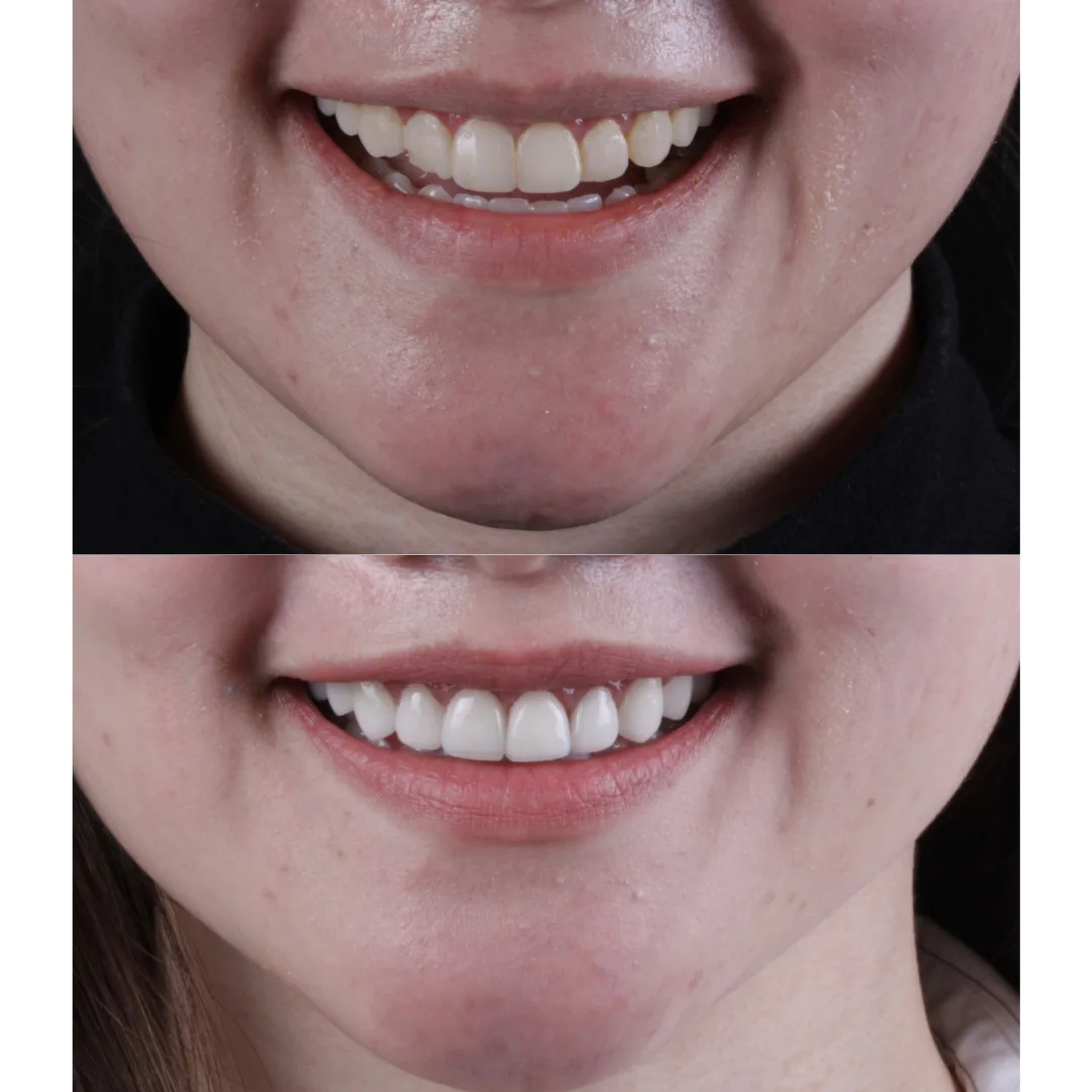 Top Left : Before smile makeover with spacing issues – Rarity Dental Gurgaon 
 Bottom Left: After treatment with even, white smile – Rarity Dental Gurgaon