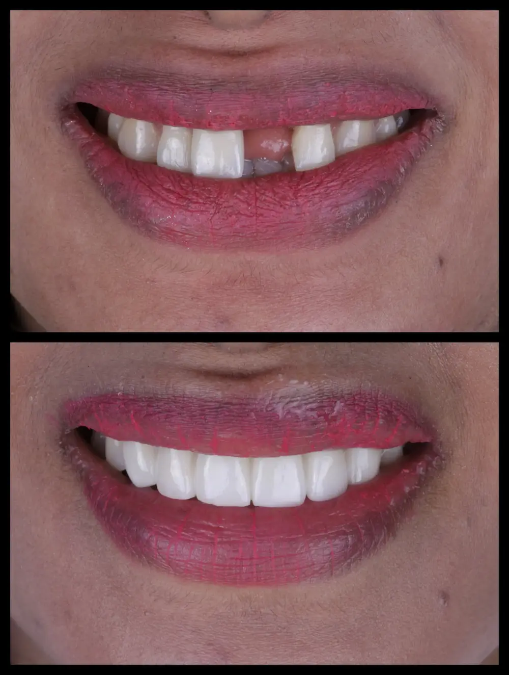 Top Right : Before smile correction with missing front tooth – Rarity Dental Gurgaon 
 Bottom Right: After cosmetic restoration of front teeth – Rarity Dental Gurgaon