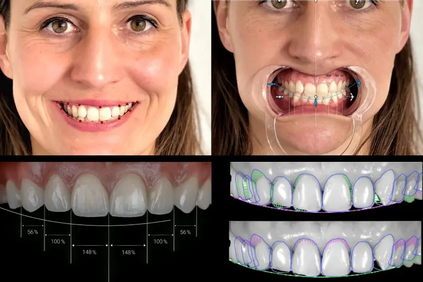 Digital Smile Designing