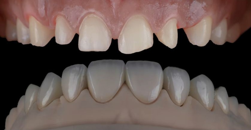 Tooth Contouring & Reshaping