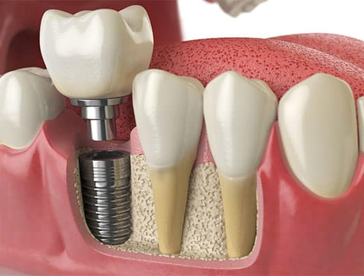 MDS - Prosthodontist & Implantologist